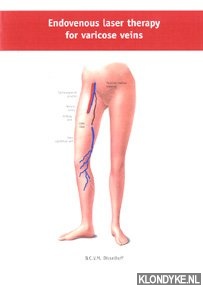 Disselhoff, B.C.V.M. - Endovenous laser therapy for varicose veins